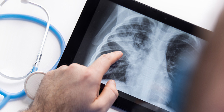 Chest x-ray